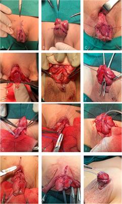 A novel modified penile disassembly procedure for isolated male epispadias repair: preliminary outcomes